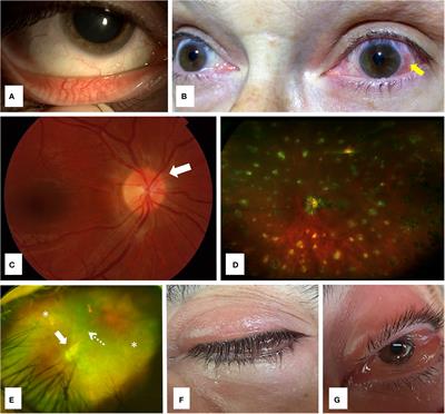 Update on ocular manifestations of the main monogenic and polygenic autoinflammatory diseases